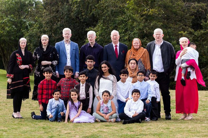 Horrifically Bullied: British Pakistani Albino Family – Asiana.tv